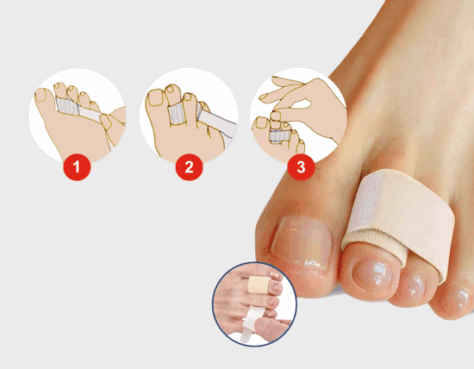 Stabileringsbandet – Hammartå